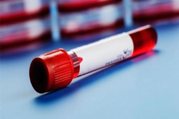 Hemogram Rbc Nasıl Yapılır? Hemogram Rbc Nasıl Yapılır?